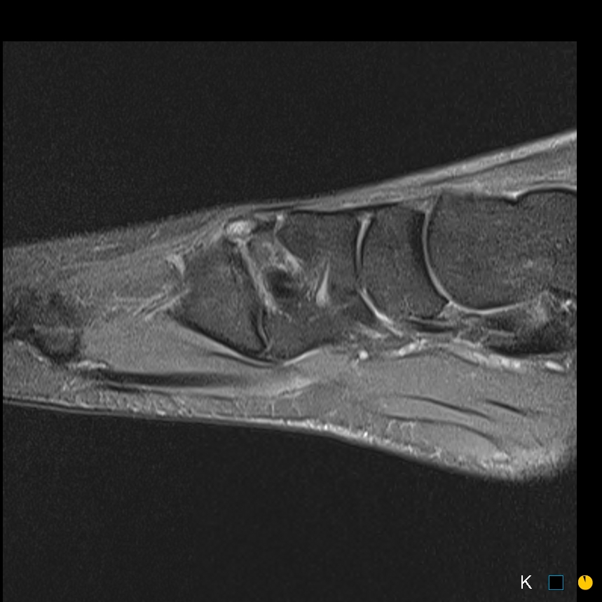 Figure 2 for case Symptomatic os intermetatarseum